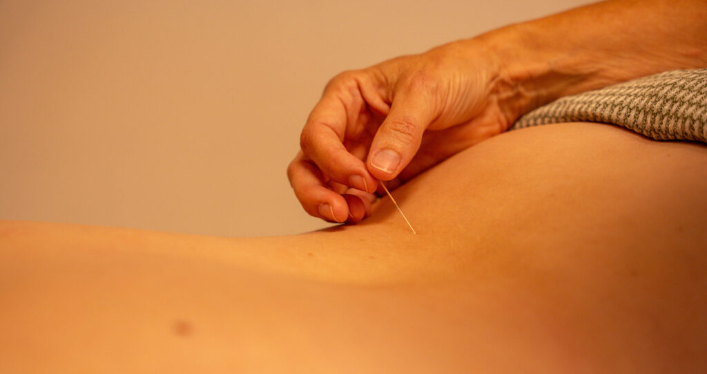 Acupunctuur Waarland